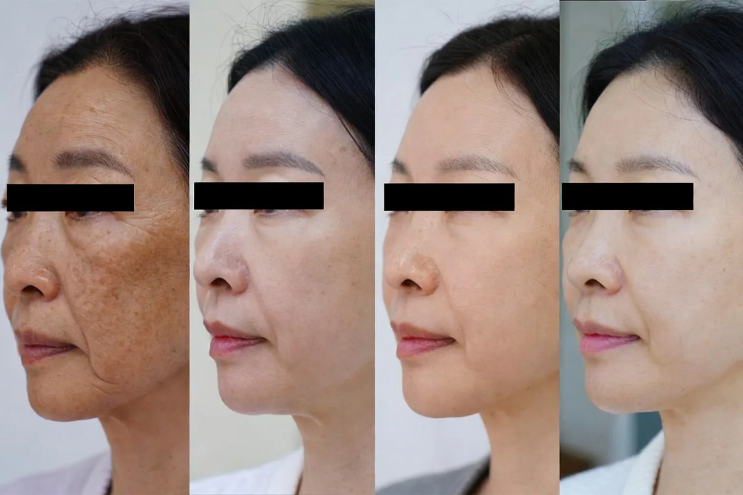 기미·색소 레이저 치료 전후 경과